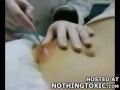 Najwi�kszy pryszcz na �wiecie - tylko na widz�w o mocnym �o��dku!